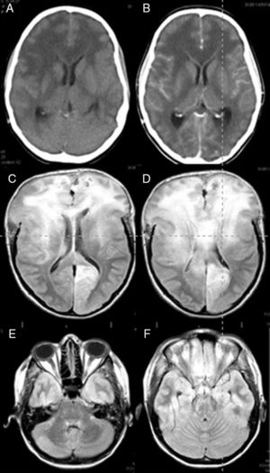 Brain CT (A and B) and FLAIR MRI (C–F) images. (A) Predominant presence of diffuse white matter hypodensity in both frontal lobes and involvement of the corpus callosum indicating vasogenic oedema. Convexity sulci effacement is seen. (B) Image was taken after the administration of contrast, showing no focal enhancement. (C) Signs of intracranial hypertension involving both frontal lobes and the corpus callosum are present. (D) Brain herniation persists despite extensive bilateral frontal craniectomy. (E and F) Infratentorial diffuse involvement is also present.