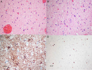 Photomicrographs showing frozen and permanent sections. (A) Haematoxylin–eosin stain. Proliferation of moderate cellularity characterised by the presence of naked nuclei (arrows) can be observed. (B) Haematoxylin–eosin stain. Oligodendroglial lineage cells are abundant. Glial elements composed of bare spindle-shaped moderately atypical nuclei can be seen (arrows). (C) Immunohistochemical GFAP (glial fibrillary acidic protein) staining showing atypical astrocytic elements with short irregular coarse extensions (arrows). (D) Ki67 staining showing proliferative activity around 2%. A, B, and D: original magnification 10×; C: original magnification 40×.