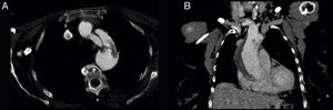 Chest CT-angiography: axial (A) and coronal (B) planes revealing an intimal flap in the ascending aorta.