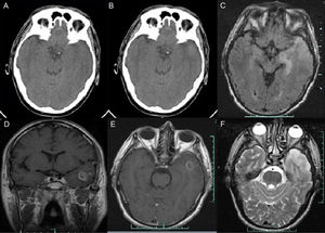 Brain CT: (A) Findings from the initial non-contrast cranial CT scan were normal. (B) Contrast brain CT image at 24hours revealing a hyperdense area in the left temporal lobe, infiltrating the ipsilateral Sylvian fissure with no contrast uptake. Brain MRI: (C) Axial T1-weighted sequence. A hyperintense lesion was observed in the left temporal lobe. (D) Coronal contrast T1-weighted sequence. An irregular lesion with a hypointense centre (ring enhancement) was identified. (E) Axial contrast T1-weighted sequence. The scan revealed an irregular area with low contrast with a cyst-like component and central necrosis exerting a mass effect with left temporal horn effacement. F) Axial T2-weighted sequence. A left temporal hyperintense lesion (oedema) was observed. MRI results: glial tumour in the left temporal lobe expanding into the uncus and hippocampus with a cyst-like appearance and central necrosis with an infiltrative/expansive growth pattern.