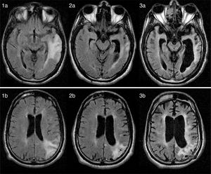 (1a and 1b) Axial FLAIR MR images (12 months after symptom onset) showing diffuse hyperintensities in cortical and subcortical regions of the parietal and temporal lobes. (2a/b, 3a/b) Axial FLAIR MR images (26 months and 8 years after symptom onset, respectively) revealing disease progression, with severe cerebellar and brainstem atrophy and a diffuse, extensive lesion to the periventricular white matter.