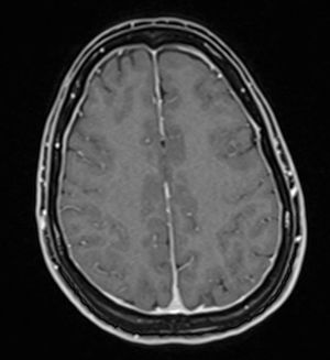 Brain MRI: axial T1-weighted contrast-enhanced sequence showing smooth dural enhancement.