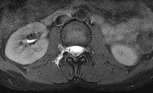 Lumbar MR myelography: extravasation of CSF with contrast uptake.