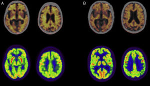 Positron emission tomography (PET) studies with florbetapir (upper row; images fused with CT) and 18F-fluorodeoxyglucose (FDG; lower row) in patients diagnosed with Alzheimer disease. (A) Woman aged 79 diagnosed with typical Alzheimer disease. The PET study with florbetapir gives a positive result for cortical amyloid plaques. The PET-FDG study indicates hypometabolism in the posterior association cortex, predominantly on the left side. (B) Man aged 57 diagnosed with left/language variant Alzheimer disease. The PET study with florbetapir gives a positive result for cortical amyloid plaques. The PET-FDG study indicates hypometabolism in the posterior association cortex, predominantly on the left side.