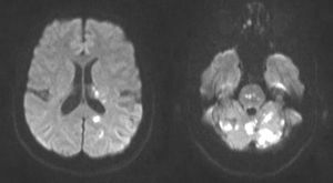 Brain diffusion-weighted MR images showing multiple areas of abnormal diffusion restriction; these are mostly rounded or punctiform, located at the left paraventricular level and the ipsilateral temporal lobe. The remaining areas are located in the vertebrobasilar territory: the pons, left occipital lobe, and especially the vermis and both cerebellar hemispheres.