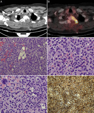 PET scans of the T2 vertebra (A and B), showing high levels of FDG uptake, with a SUVmax of 18.6 (B). Anatomical pathology revealed a neoplasm with a diffuse growth pattern, made up of round or oval mononuclear cells and abundant eosinophilic cytoplasm (C and E: haematoxylin and eosin staining; magnification 40× and 100×, respectively). These are accompanied by foam cells, siderophages, and multinucleated giant cells. Mitotic rate was low (D: haematoxylin and eosin staining; 400×), and there were localised areas of necrosis and lymphocytic infiltrate. Immunohistochemical analysis revealed CD68 positivity (F).