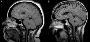 MRI scan. Sagittal, T1-weighted FLAIR sequence. (A) A 41-year-old woman with bulbospinal-onset ALS manifesting 6 months previously. The shape, position, and signal intensity of her tongue were normal, including the internal structures. (B) A 49-year-old man with bulbospinal-onset ALS manifesting 23 months previously. Abnormalities can be observed in the shape, position, and signal intensity of the tongue; the internal structure is lost.