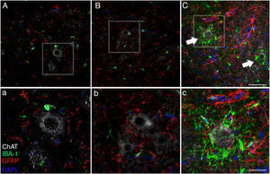 Forty-five days after surgery, the increased glial reactivity and microglial response in the cALS-CSF group was evident in all regions studied. For example, the anterior horn (lumbar segment) of rats in the cALS-CSF group displayed greater expression of GFAP, with numerous hypertrophic astrocytes (panels C, c). Furthermore, we identified a higher density of Iba1+ cells with enlarged processes; these were often in close proximity to or even surrounding the neurons (arrows in panel C; detail in panel c). These changes were not observed in the sham or non-ALS-CSF groups, in which isolated microglial cells were occasionally observed close to motor neurons. Scale bar: A–C, 60 μm; a–c, 30 μm.