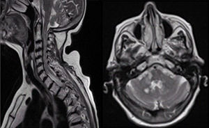 Left: cervical MRI scan, sagittal plane, T2-weighted sequence. Hyperintensity in the spinal cord. Right: brain MRI scan, axial plane, T2-weighted sequence. Multiple round hyperintense lesions in the cerebellum.