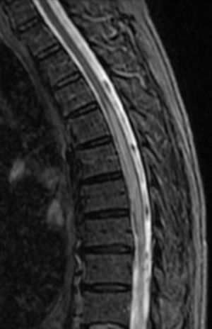 Sagittal cervico-thoracic STIR MRI sequence: increased volume and signal intensity in the spinal cord between T4 and T8, predominantly anterior and compatible with myelitis.