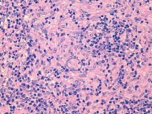 Biopsy of the lesion with haematoxylin and eosin stain, revealing a lymphoplasmacytic inflammatory infiltrate with non-caseating granulomatomas and amastigotes (circle).