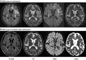 (A) Brain MRI revealing cortical and subcortical hyperintensity in both insular areas, the left temporal lobe, and the parasagittal frontal lobe on T2-weighted and FLAIR sequences. DWI showed cortical signal alterations in all these areas, with no abnormal diffusion restriction in the ADC map. (B) A second MRI scan performed 2 months later revealed that lesions had disappeared.