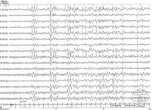 Electroencephalography reading showing a generalised synchronous, symmetrical, 3.5-Hz spike-and-wave discharge.