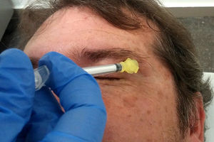 Lacrimal nerve block. The needle is inserted through the eyebrow tail and is directed upwards and sidewards to the temple. The anaesthetic solution is injected into the subcutaneous tissue.