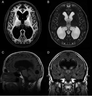 Preoperative MR image of a patient with idiopathic normal-pressure hydrocephalus who responded well to ventriculoperitoneal shunting. (A) Axial T1-weighted sequence. Moderate dilatation of the lateral ventricles and the third ventricle. (B) Axial T2-weighted sequence. CSF flow artefacts in the third ventricle; absence of hyperintensity at the periventricular and subcortical levels. (C) Sagittal T1-weighted sequence. Descent of the third ventricle floor, rounding of the third ventricle, and decreased mamillopontine distance. The image shows no obstruction in the aqueduct of Sylvius that may explain ventricular dilatation. (D) Coronal FLAIR sequence. Typical pattern of effacement of convexity sulci, especially in the midline. The CSF flow signal void on the T2-weighted sequence extends towards both Monro foramina, reaching the lower and middle portions of the ventricular cavities. Absence of periventricular and subcortical hyperintensities.