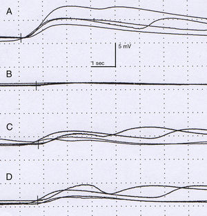 Neurophysiological study. Amplitude (mV) and latency (s). Sympathetic response of the skin after stimulating the right median nerve is normal in the right hand (A), with the left hand showing a delayed, low-amplitude response in comparison to the contralateral side. The response on the right (C) and left (D) leg shows no alterations.