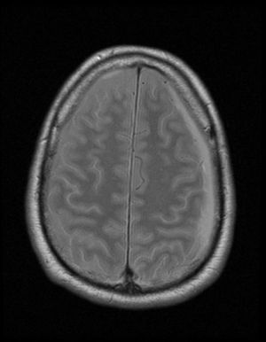 Axial proton diffusion-weighted brain MR image displaying a hyperintense left frontoparietal extra-axial collection with a maximum thickness of 1cm.