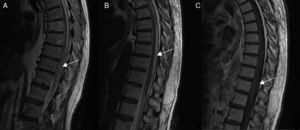 Typical radiological features of spinal AVFs on MRI. (A) T2-weighted sequence showing spinal cord hyperintensity corresponding to oedema. (B) Flow voids typical of venous congestion. (C) Serpentine vessels following contrast administration.