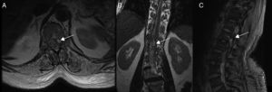 Spinal cord MRI of patient 7, showing multiple irregular artefacts in the thecal sac. (A, B) Pseudonodular hyperintensities on T2-weighted sequences. (C) Hypointensities on T2-weighted gradient-echo sequences, extending from T9 to the thecal sac; diffuse hyperintensity of CSF on T1-weighted sequences (clots distort the image of the exit of cauda equina nerve roots); and conus medullaris hyperintensity. These findings are compatible with lumbar subarachnoid haemorrhage.