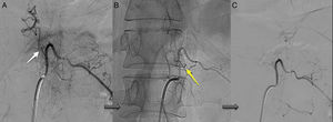 Endovascular treatment in patient 9. (A) Left-sided thoracic spinal dural AVF at the T12 level. (B) Glue embolisation. (C) Complete fistula closure after a single procedure.