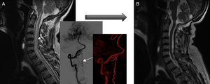 Pre- and post-surgery MRI studies of patient 3. (A) At diagnosis, the MRI scan displayed spinal cord oedema extending from the cervicomedullary junction to the chest (plus angiography reconstructions). (B) Post-treatment MRI scan (after two surgeries) showing normal signal intensity. However, gait function worsened by one point on the Aminoff-Logue scale.