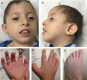 Clinical phenotype: (A and B) Wide forehead, prominent metopic ridge, permanently open mouth, and low-set ears with posterior rotation. (C) Fingertip pads. (D and E) Broad fingers and toes, especially the thumb and toe.