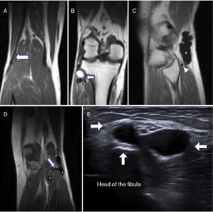 Patient 1: (A and B) Coronal MRI section showing the beginning and the end of the lesion. Patient 2: (C) Sagittal MRI section showing a cyst-like ganglion (asterisk) and the dilated section of the articular branch (arrowhead). (D) Coronal MRI section showing how the common peroneal nerve is affected in the area proximal to the superior tibiofibular joint and its distal extension, with bifurcation into a superficial and deep component, demonstrating the connection with the superior tibiofibular joint (outlined arrow). (E) Ultrasound image revealing the ganglion cyst limits at the articular level (white arrows).