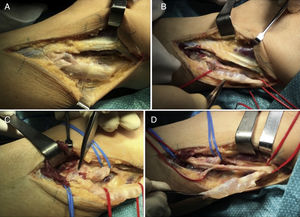 (A) Lateral approach by planes. (B) Ganglion cyst dissection and delimitation, revealing its cystic composition. (C) The dissecting forceps indicates the area where the superior tibiofibular joint connects with the articular branch. (D) Epineurotomy and resection of the intraneural ganglion cyst.