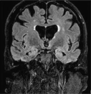 Brain MRI (FLAIR) scan: coronal section showing hyperintensity in both temporal lobes.