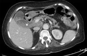 CT scan: polylobulated tumour in the hepatic hilum and peripancreatic area, surrounding vessels with no signs of obstruction. These findings are suggestive of lymphoma, but do not allow us to rule out pancreatic carcinoma.