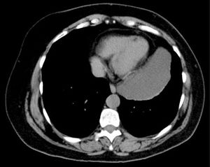Chest CT scan: mass in the left side of the anterior mediastinum extending from the aortic arch to the diaphragm, with no signs of infiltration and a density similar to that of water. Measurements: 111mm (anteroposterior)×58mm (transverse)×167mm (vertical).