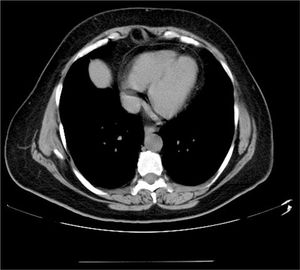 Chest CT scan at 6 years showing complete mass regression.
