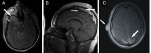 MRI scan. (A) Axial T2-weighted sequence with CSF signal suppression showing atrophy of the right temporal lobe (small arrow) and a well-defined, hyperintense cystic lesion in the middle fossa, corresponding to an arachnoid cyst (large arrow). (B) Sagittal T1-weighted sequence displaying typical features of Haberland syndrome: extensive hyperintensity adjacent to the superior convexity and midline, corresponding to intracranial lipomatosis (large arrow); hypointense cortical calcifications located below the lipomatous area (small arrows); and subcutaneous tumours on the scalp (asterisk). (C) Axial T1-weighted sequence at the level of the semioval centres: the lipomatous lesions are clearly visible in the posterior midline (large arrow). The image also displays a benign soft-tissue tumour on the right side of the temporal squama (small arrow).