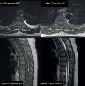 Thoracic MRI: axial and sagittal T1-weighted sequence without contrast and T2-weighted sequence. A posterior isointense epidural mass extends from T5 to T8, compressing the posterior section of the spinal cord. The scan also reveals multiple bone lesions in the thoracolumbar spine, involving both the posterior elements and the vertebral bodies of all dorsal vertebrae and L1.