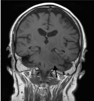 Brain MRI, coronal T1-weighted sequence showing that the lesion originated in the pons.
