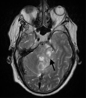 Brain MRI, axial T2-weighted sequence displaying the extension of the lesion across the cerebellum and peduncle.