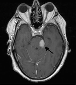 Brain MRI, gadolinium-enhanced axial T1-weighted sequence.