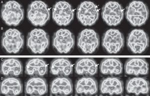 Brain perfusion SPECT scan with 99mTc-HMPAO, performed at diagnosis. Axial (A) and coronal (C) sequences showing hyperperfusion in the left temporal cortex (long arrows), predominantly in the superior lateral area and the insula, and extending to the adjacent frontotemporal area (Broca area) (dotted arrow). Hyperperfusion was less marked and less extensive in the right temporal cortex (short arrows). A follow-up study conducted after 5 months (B and D) revealed nearly complete resolution of abnormal brain perfusion.
