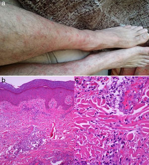 Erythematous nodules typical of Sweet syndrome (a). Skin biopsy: haematoxylin-eosin stain showing intradermal neutrophil infiltration with no vascular involvement or microthrombosis (b and c).