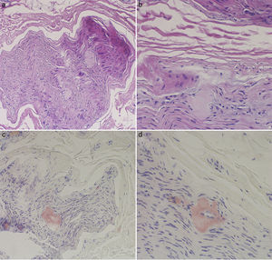 Sural nerve biopsy. Haematoxylin and eosin (A and B) and Congo red (C and D) staining. The endoneurium shows amorphous, eosinophilic hyaline deposits that are positive for Congo red.
