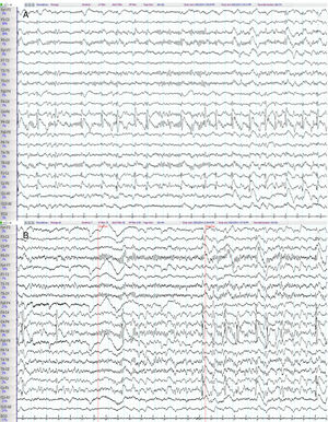 Baseline electroencephalography. (A) Frequent epileptiform discharges consisting of 1-Hz spike-and-wave complexes are observed on the right parietal region and midline (C4-P4, P4-O2, Fz-Cz, Cz-Pz), occasionally radiating to the adjacent areas. (B) A parieto-occipital alpha rhythm is recorded in the posterior regions (P3-O1, T5-O1, P4-O2, T6-O2); this rhythm was reactive to the closing of the eyes and attenuated when eyes opened.