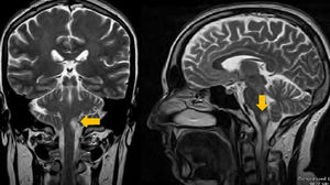 MRI scan. Coronal and sagittal T2-weighted sequences showing an infarction in the left side of the medulla oblongata (arrows).