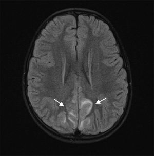 Axial T2-weighted FLAIR MRI sequence showing bilateral occipital and posterior parietal cortico-subcortical hyperintensities, which are nearly symmetrical (arrows).
