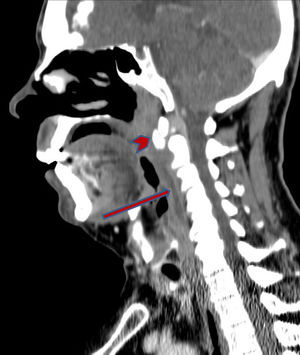 Sagittal CT scan of the neck with IV contrast revealing a prevertebral fluid collection with no peripheral contrast uptake (arrow) and calcification in the longus colli muscle at the C2 level (arrowhead).