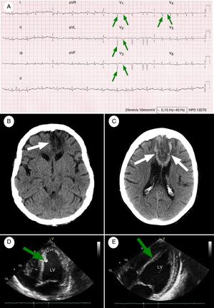 Baseline and follow-up complementary tests. (A) 12-Lead ECG performed at admission (26 hours after symptom onset): AF at a rate of 114bpm, with pathological Q waves and inverted T waves in precordial leads V1-V4 (green arrows), indicating necrosis in the anterior wall of the left ventricle and interventricular septum (paper speed, 25mm/s). (B) Simple head CT scan performed at baseline: wedge-shaped hypodense area in the territory of the left ACA, affecting the corpus callosum (white arrow), the territory of the recurrent artery of Heubner, and the orbitofrontal, medial, and superior regions of the left frontal lobe. (C) Simple head CT scan (8 days after symptom onset) showing hypodense areas with haemorrhagic transformation, associated with subacute strokes in the territory of both ACAs (white arrows). Dark areas: ischaemia; white areas: haemorrhage. (D) TTE at admission: akinetic area at the apex of the heart during diastole, and hyperechogenic area around the interventricular septum, compatible with a mural thrombus (green arrow). These findings were associated with a left ventricular ejection fraction (LVEF) of up to 45% during systole. (E) A follow-up TTE performed 6 months after admission showed considerable improvements in the motility of the anteroapical wall of the left ventricle, near-complete disappearance of the mural thrombus (green arrow), and an LVEF of 60%. LV: left ventricle.