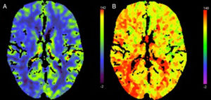 Perfusion CT scan from patient 7. Right hemisphere syndrome (NIHSS score: 6). (A) Decreased CBF in the right hemisphere. (B) Longer Tmax at a similar location in the cortex. Changes do not clearly correspond to a specific vascular territory. CT-angiography revealed no large-vessel occlusion.