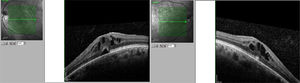 Cystoid macular oedema in the right and the left eyes, one week after onset of treatment with fingolimod.