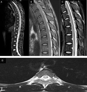 MR image of the thoracic spinal cord. (A-C) Sagittal T2-weighted and FLAIR sequences showing a longitudinally extensive hyperintensity in the anterior part of the spinal cord. (D) Axial plane of the thoracic region at the T2 level, showing a hyperintense lesion.
