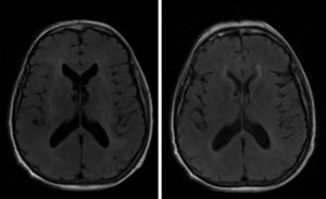Brain MRI. T2-weighted FLAIR sequence. A) Baseline: bilateral diffuse involvement of the white matter, except for the U-shaped fibres. B) Three months after tumour resection: decreased leukoencephalopathy (barely visible).