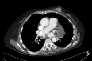 Full-body CT scan. Nodular lesion with poorly-defined edges in the left thoracic wall, corresponding to breast cancer.